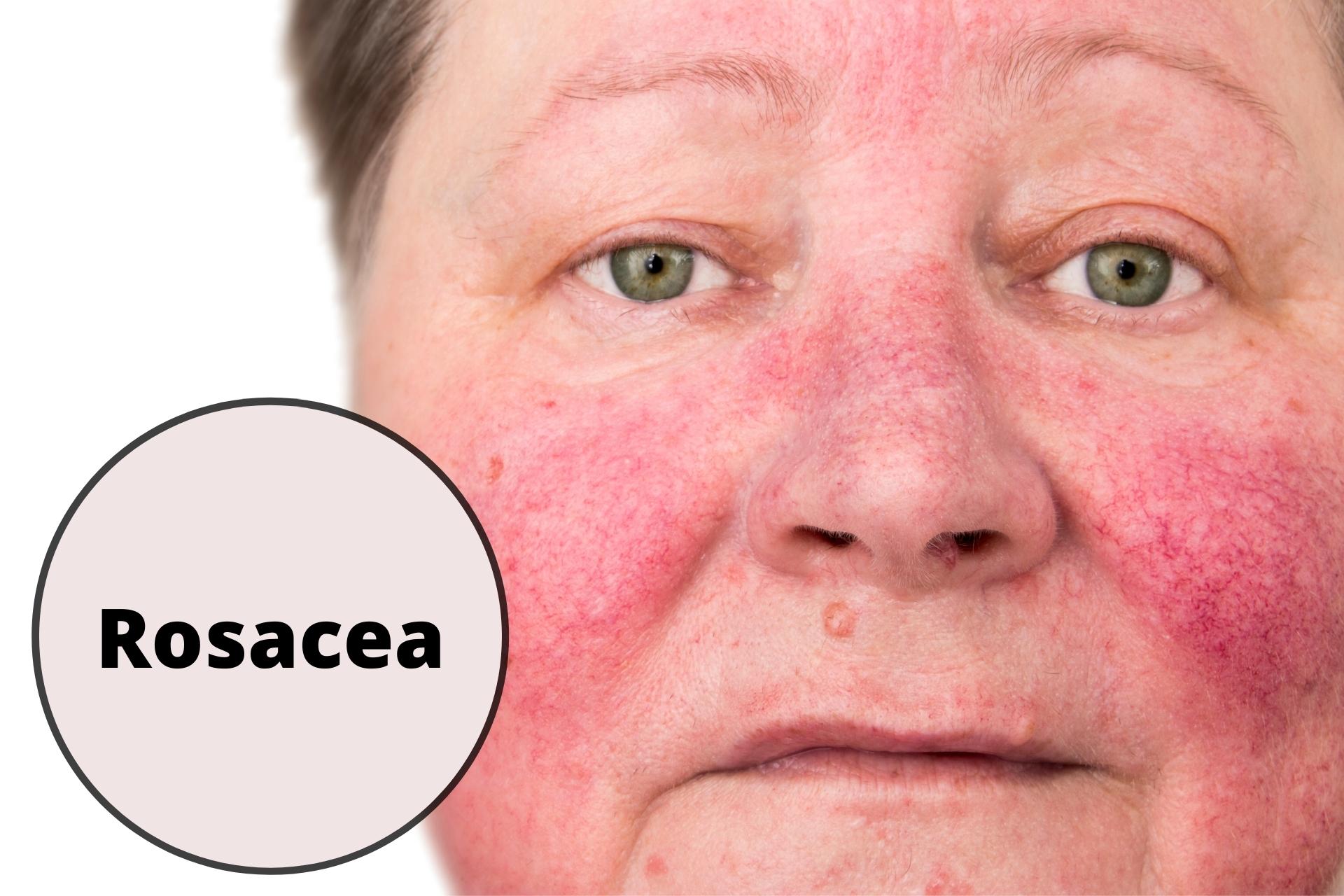 Kvinde med hudsygdommen rosacea | Fazion